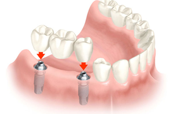 Dental Bridges