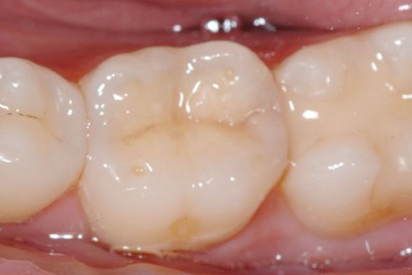 Composite Fillings