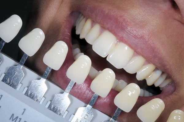 Veneers