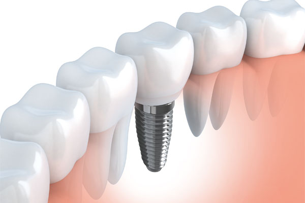 Dental Implants